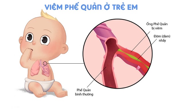 Trẻ bị viêm phế quản: Triệu chứng, điều trị và cách chăm sóc
