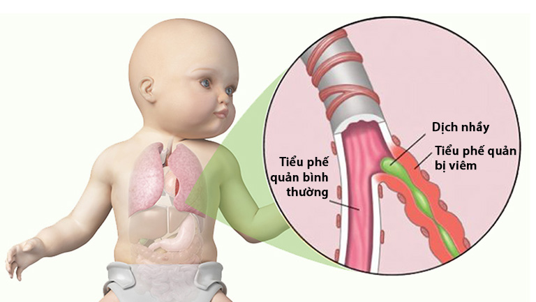 Trẻ viêm tiểu phế quản ở trẻ